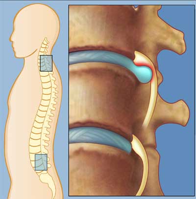 anatomia-da-hernia-de-disco Hérnia de Disco: O Que É, Como Se Desenvolve e Tratamentos