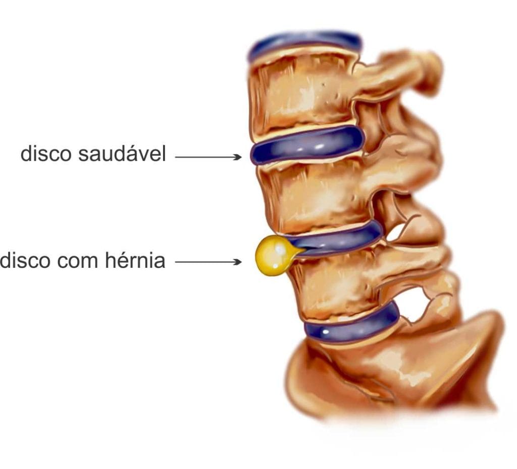 hernia-de-disco-foto-1024x930-1 Hérnia de Disco: O Que É, Como Se Desenvolve e Tratamentos