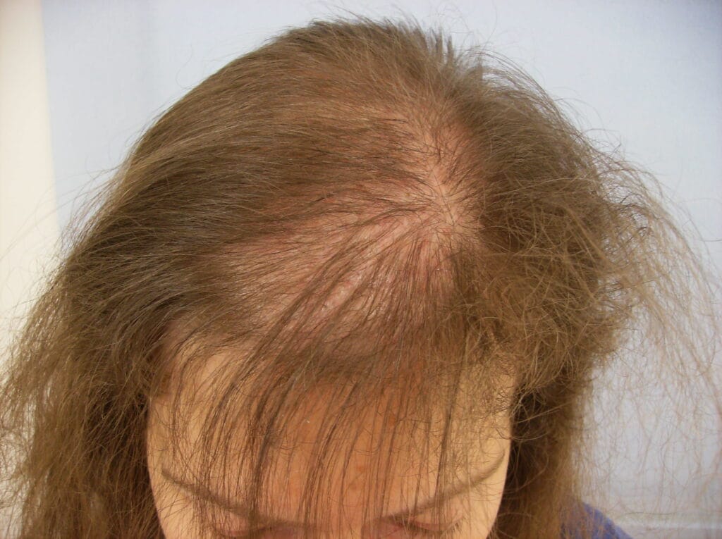 4a-Alopecia-DEFLUVIUM-A-003-1024x765 Calvície: Causas, Sinais Iniciais e Como Evitar