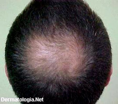 alopecia31-2 Calvície: Causas, Sinais Iniciais e Como Evitar